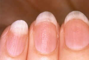 Dry-Brittle-Nails