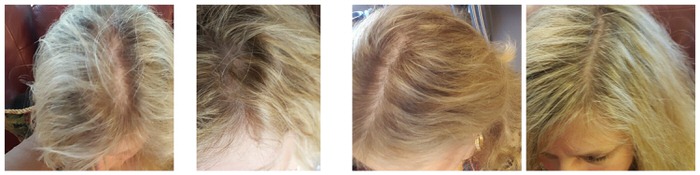Does Irestore Work for Women Before After Pictures Laser Cap Therapy laser caps really work for thinning hair