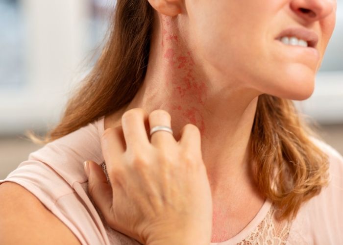 Understanding the Treatment Ladder for Moderate-to-Severe Atopic Dermatitis woman scratching